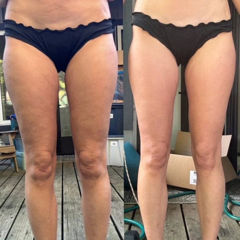 Eccoba™ - Anti-Cellulite Massager